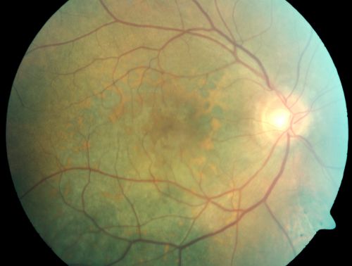 Pigmented Choroidal Mass Right Eye - Melanoma vs. Nevus vs. Unilateral Melanocytic Proliferation - 4 Month Follow-Up Images
71-year-old man his vision 4 month follow-up.  Vision is 20/60 and patient sees flashing lights.  Lesion has grown slightly in the superior half of the macula.
