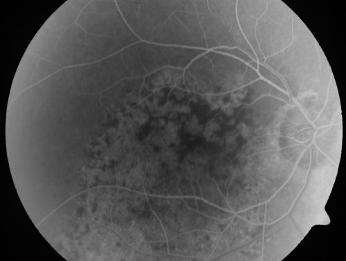 Pigmented Choroidal Mass Right Eye - Melanoma vs. Nevus vs. Unilateral Melanocytic Proliferation - 4 Month Follow-Up Images
71-year-old man his vision 4 month follow-up.  Vision is 20/60 and patient sees flashing lights.  Lesion has grown slightly in the superior half of the macula.
