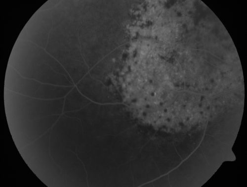 Pigmented Choroidal Mass Right Eye - Melanoma vs. Nevus vs. Unilateral Melanocytic Proliferation - 4 Month Follow-Up Images 
71-year-old man his vision 4 month follow-up.  Vision is 20/60 and patient sees flashing lights.  Lesion has grown slightly in the superior half of the macula.
