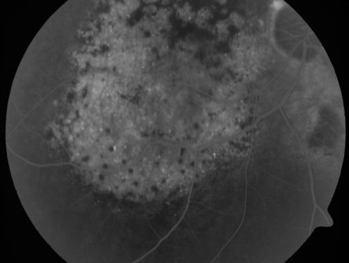 Pigmented Choroidal Mass Right Eye - Melanoma vs. Nevus vs. Unilateral Melanocytic Proliferation - 4 Month Follow-Up Images
71-year-old man his vision 4 month follow-up.  Vision is 20/60 and patient sees flashing lights.  Lesion has grown slightly in the superior half of the macula.
