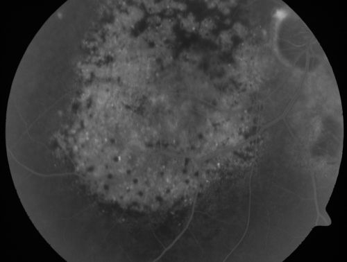 Pigmented Choroidal Mass Right Eye - Melanoma vs. Nevus vs. Unilateral Melanocytic Proliferation - 4 Month Follow-Up Images
71-year-old man his vision 4 month follow-up.  Vision is 20/60 and patient sees flashing lights.  Lesion has grown slightly in the superior half of the macula.
