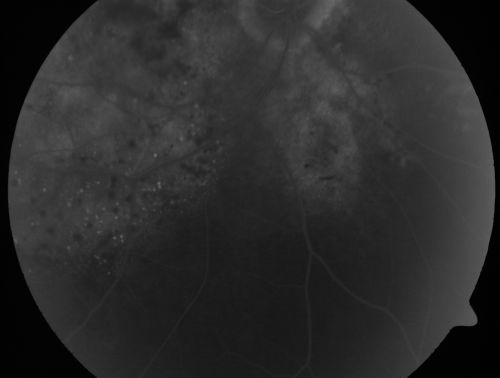 Pigmented Choroidal Mass Right Eye - Melanoma vs. Nevus vs. Unilateral Melanocytic Proliferation - 4 Month Follow-Up Images
71-year-old man his vision 4 month follow-up.  Vision is 20/60 and patient sees flashing lights.  Lesion has grown slightly in the superior half of the macula.
