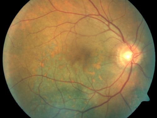 Pigmented Choroidal Mass Right Eye - Melanoma vs. Nevus vs. Unilateral Melanocytic Proliferation - Initial Visit
71-year-old man is vision has been bothering him for about a month.  He does not notice one eye particularly worse than the other.  OD is 20/40, OS is 20/25 - Initial Visit
