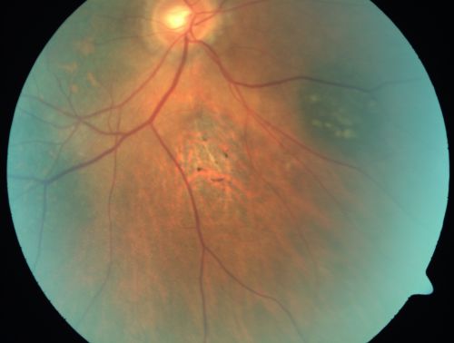 Pigmented Choroidal Mass Right Eye - Melanoma vs. Nevus vs. Unilateral Melanocytic Proliferation - Initial Visit
71-year-old man is vision has been bothering him for about a month.  He does not notice one eye particularly worse than the other.  OD is 20/40, OS is 20/25 - Initial Visit
