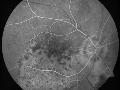Pigmented Choroidal Mass Right Eye - Melanoma vs. Nevus vs. Unilateral Melanocytic Proliferation - Initial Visit
71-year-old man is vision has been bothering him for about a month.  He does not notice one eye particularly worse than the other.  OD is 20/40, OS is 20/25 - Initial Visit
