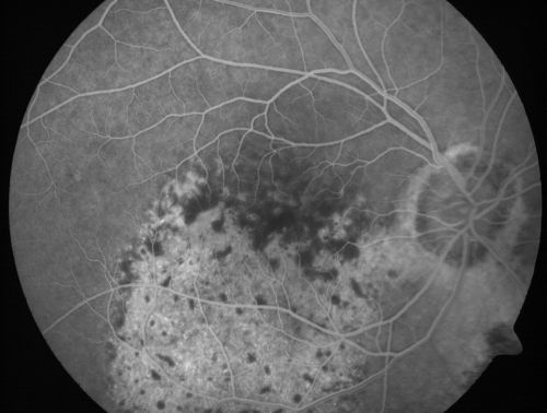 Pigmented Choroidal Mass Right Eye - Melanoma vs. Nevus vs. Unilateral Melanocytic Proliferation - Initial Visit
71-year-old man is vision has been bothering him for about a month.  He does not notice one eye particularly worse than the other.  OD is 20/40, OS is 20/25 - Initial Visit
