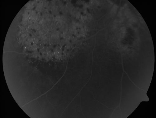 Pigmented Choroidal Mass Right Eye - Melanoma vs. Nevus vs. Unilateral Melanocytic Proliferation - Initial Visit
71-year-old man is vision has been bothering him for about a month.  He does not notice one eye particularly worse than the other.  OD is 20/40, OS is 20/25 - Initial Visit71-year-old man is vision has been bothering him for about a month.  He does not notice one eye particularly worse than the other.  OD is 20/40, OS is 20/25 - Initial Visit
