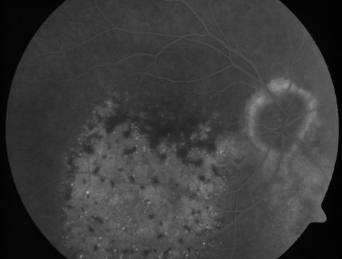 Pigmented Choroidal Mass Right Eye - Melanoma vs. Nevus vs. Unilateral Melanocytic Proliferation - Initial Visit
71-year-old man is vision has been bothering him for about a month.  He does not notice one eye particularly worse than the other.  OD is 20/40, OS is 20/25 - Initial Visit
