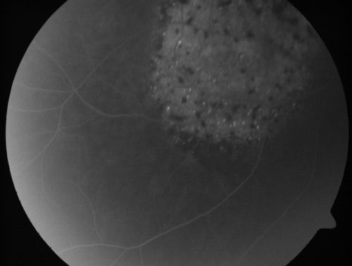 Pigmented Choroidal Mass Right Eye - Melanoma vs. Nevus vs. Unilateral Melanocytic Proliferation - Initial Visit
71-year-old man is vision has been bothering him for about a month.  He does not notice one eye particularly worse than the other.  OD is 20/40, OS is 20/25 - Initial Visit
