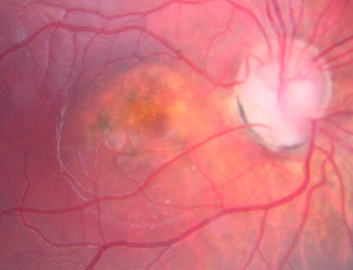 Optic Nerve Pit Retinal Detachment - SD OCT of Nerve EDI shows Pit
9 Year old with morning glory disc who developed nerve pit RD.  Raster scans of the optic nerve on EDI setting show the communication between the subretinal space and the fluid around the cerebrospinal fluid surrounding the optic nerve sheath.
