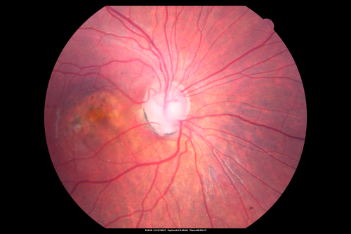 Optic Nerve Pit Maculopathy
10 year old child who had inner retinal fenestration (see youtube video on scohen125 channel) and did very well.
