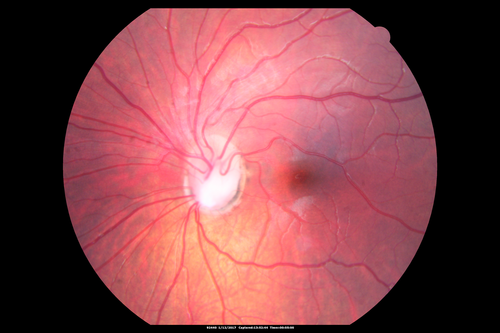 Optic Nerve Pit Retinal Detachment - SD OCT of Nerve EDI shows Pit
9 Year old with morning glory disc who developed nerve pit RD.  Raster scans of the optic nerve on EDI setting show the communication between the subretinal space and the fluid around the cerebrospinal fluid surrounding the optic nerve sheath.
