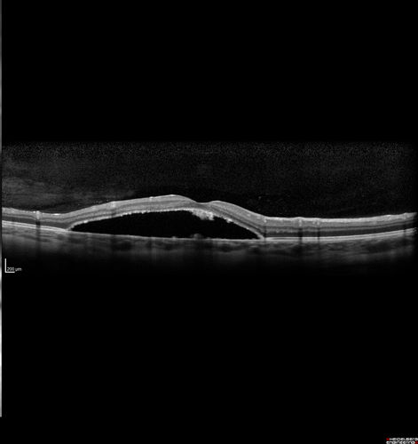 Optic Nerve Pit Maculopathy
10 year old child who had inner retinal fenestration (see youtube video on scohen125 channel) and did very well.
