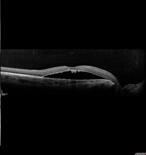 Optic Nerve Pit Maculopathy
10 year old child who had inner retinal fenestration (see youtube video on scohen125 channel) and did very well.
