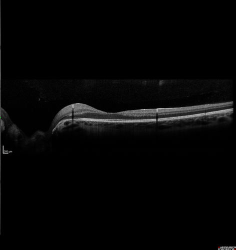 Optic Nerve Pit Maculopathy
10 year old child who had inner retinal fenestration (see youtube video on scohen125 channel) and did very well.
