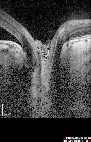 Optic Nerve Pit Maculopathy
10 year old child who had inner retinal fenestration (see youtube video on scohen125 channel) and did very well.
