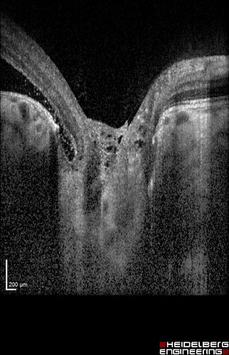 Optic Nerve Pit Maculopathy
10 year old child who had inner retinal fenestration (see youtube video on scohen125 channel) and did very well.
