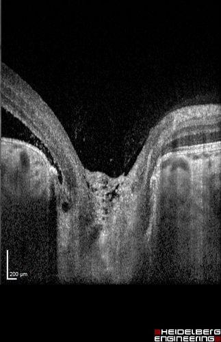 Optic Nerve Pit Retinal Detachment - SD OCT of Nerve EDI shows Pit
9 Year old with morning glory disc who developed nerve pit RD.  Raster scans of the optic nerve on EDI setting show the communication between the subretinal space and the fluid around the cerebrospinal fluid surrounding the optic nerve sheath.
