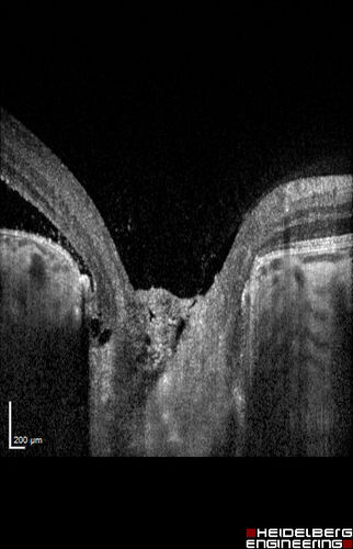 Optic Nerve Pit Maculopathy
10 year old child who had inner retinal fenestration (see youtube video on scohen125 channel) and did very well.
