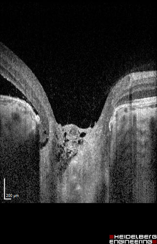 Optic Nerve Pit Maculopathy
10 year old child who had inner retinal fenestration (see youtube video on scohen125 channel) and did very well.
