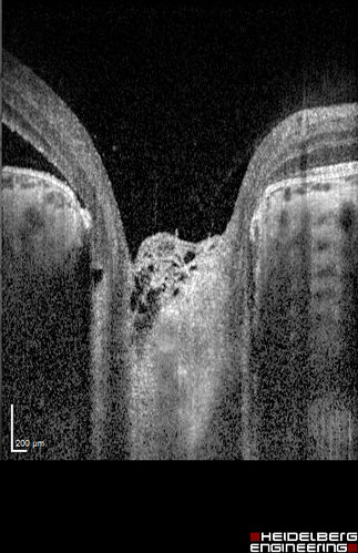 Optic Nerve Pit Maculopathy
10 year old child who had inner retinal fenestration (see youtube video on scohen125 channel) and did very well.
