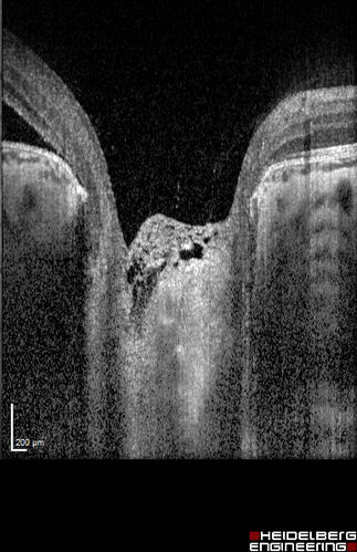 Optic Nerve Pit Maculopathy
10 year old child who had inner retinal fenestration (see youtube video on scohen125 channel) and did very well.
