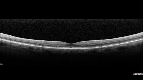 Hydroxychloroquine Toxicity - Mild
71 year old female with 200 mg BID plaquenil for 25 years.  Recent visual field showed abnomality.  FAF shows hyper FAF temporally and OCT shows mild outer retinal atrophy
