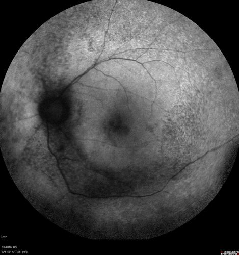 hydroxychloroquine (Plaquenil) Toxicity - Taiwanese 56 year old female (Asian)
56 year old female on 400 mg plaquenil for 22 years presents with vision loss.  VA 20/50 both eyes.  Plaquenil was stopped.  The vision in the left eye continued to deteriorate to 3/200.  5'2" 127 lb (6.6 mg/kg body weight)
