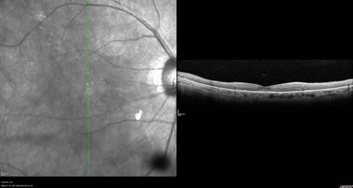 hydroxychloroquine  (Plaquenil) Toxicity - Taiwanese 56 year old female (Asian)
56 year old female on 400 mg plaquenil for 22 years presents with vision loss.  VA 20/50 both eyes.  Plaquenil was stopped.  The vision in the left eye continued to deteriorate to 3/200.  5'2" 127 lb (6.6 mg/kg body weight)

