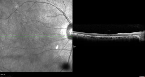 hydroxychloroquine (Plaquenil) Toxicity - Taiwanese 56 year old female (Asian)
56 year old female on 400 mg plaquenil for 22 years presents with vision loss.  VA 20/50 both eyes.  Plaquenil was stopped.  The vision in the left eye continued to deteriorate to 3/200.  5'2" 127 lb (6.6 mg/kg body weight)
