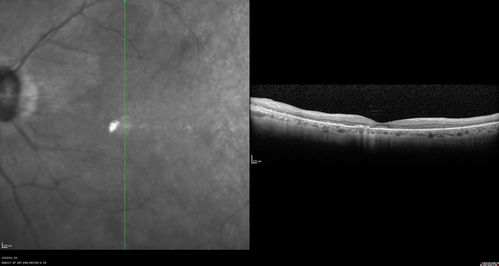 Hydroxychlorquine (Plaquenil) Toxicity - Taiwanese 56 year old female (Asian)
56 year old female on 400 mg plaquenil for 22 years presents with vision loss.  VA 20/50 both eyes.  Plaquenil was stopped.  The vision in the left eye continued to deteriorate to 3/200.  5'2" 127 lb (6.6 mg/kg body weight)
