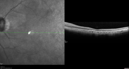 hydroxychloroquine (Plaquenil) Toxicity - Taiwanese 56 year old female (Asian)
56 year old female on 400 mg plaquenil for 22 years presents with vision loss.  VA 20/50 both eyes.  Plaquenil was stopped.  The vision in the left eye continued to deteriorate to 3/200.  5'2" 127 lb (6.6 mg/kg body weight)
