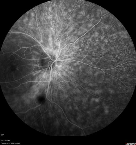 hydroxychloroquine (Plaquenil) Toxicity - Taiwanese 56 year old female (Asian)
56 year old female on 400 mg plaquenil for 22 years presents with vision loss.  VA 20/50 both eyes.  Plaquenil was stopped.  The vision in the left eye continued to deteriorate to 3/200.  5'2" 127 lb (6.6 mg/kg body weight)
