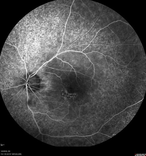 Hydroxychlorquine (Plaquenil) Toxicity - Taiwanese 56 year old female (Asian)
56 year old female on 400 mg plaquenil for 22 years presents with vision loss.  VA 20/50 both eyes.  Plaquenil was stopped.  The vision in the left eye continued to deteriorate to 3/200.  5'2" 127 lb (6.6 mg/kg body weight)
