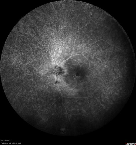hydroxychloroquine (Plaquenil) Toxicity - Taiwanese 56 year old female (Asian)
56 year old female on 400 mg plaquenil for 22 years presents with vision loss.  VA 20/50 both eyes.  Plaquenil was stopped.  The vision in the left eye continued to deteriorate to 3/200.  5'2" 127 lb (6.6 mg/kg body weight)
