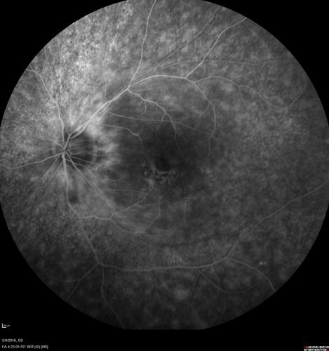 hydroxychloroquine (Plaquenil) Toxicity - Taiwanese 56 year old female (Asian)
56 year old female on 400 mg plaquenil for 22 years presents with vision loss.  VA 20/50 both eyes.  Plaquenil was stopped.  The vision in the left eye continued to deteriorate to 3/200.  5'2" 127 lb (6.6 mg/kg body weight)
