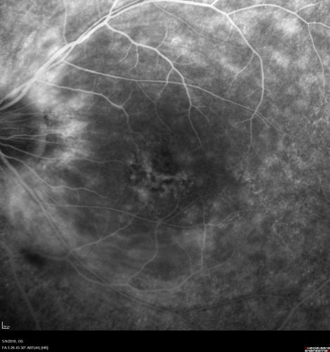 hydroxychloroquine (Plaquenil) Toxicity - Taiwanese 56 year old female (Asian)
56 year old female on 400 mg plaquenil for 22 years presents with vision loss.  VA 20/50 both eyes.  Plaquenil was stopped.  The vision in the left eye continued to deteriorate to 3/200.  5'2" 127 lb (6.6 mg/kg body weight)
