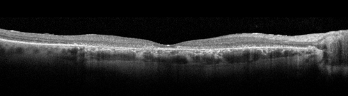 Plaquenil Toxicity - Bull's Eye Maculopathy - 25 Years Therapy - OCT Line Scan
73-year-old woman has been on Plaquenil for twenty five years. Plaquenil has now been stopped for 6 months.  VA continues to decline as does visual function - 20/80 OD , 20/40 OS
