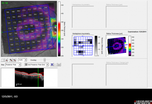 Plaquenil Toxicity - Bull's Eye Maculopathy - 25 Years Therapy OCT Posterior Pole MAP
73-year-old woman has been on Plaquenil for twenty five years. Plaquenil has now been stopped for 6 months.  VA continues to decline as does visual function - 20/80 OD , 20/40 OS
