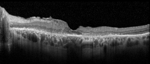 Plaquenil Toxicity - Bull's Eye Maculopathy - 25 Years Therapy OCT Line Scan
73-year-old woman has been on Plaquenil for twenty five years. Plaquenil has now been stopped for 6 months.  VA continues to decline as does visual function - 20/80 OD , 20/40 OS

