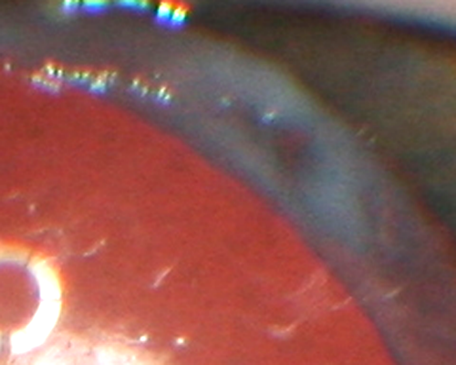 Propionibacterium acnes endophthalmitis with capsular plaque and uveitis
61 year old man with inflammation after cataract surgery who ultimately needed removal of intraocular lens and capsule to quiet eye.
