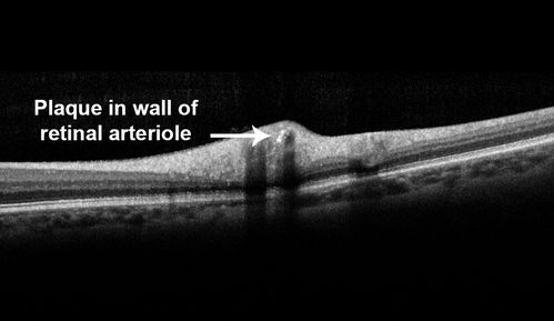Intraluminal Plaque Retinal Vessel 
69 year old female referred with atypical plaque in the right retina.  Her vision is normal.  The plaque looks to be adjacent to the blood column visible on the images and the SC OCT shows it to be in the vessel wall. 
