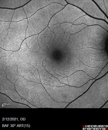 Hydroxychloroquine Toxicity
60 year old female received 6.5 mg/kg Plaquenil for 15 years and developed toxicity.  VA 20/40 OD, 20/20 OS
