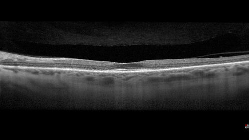 Hydroxychloroquine Toxicity
60 year old female received 6.5 mg/kg Plaquenil for 15 years and developed toxicity.  VA 20/40 OD, 20/20 OS
