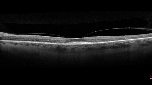 Hydroxychloroquine Toxicity
60 year old female received 6.5 mg/kg Plaquenil for 15 years and developed toxicity.  VA 20/40 OD, 20/20 OS
