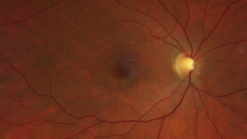 Plaquenil Toxicity - 4 years use
47 year old female She started plaquenil 4 years ago for lupus with cutaneous findings.  She has never been on the plaquenil before.  Her renal function is normal (her husband is an internist) and she is not on Tamoxifen.  Stopped the medication about 2.5 weeks ago.  She noticed vision when she started the depacote.  She is also myopic. (-9.50)  

Her dose was 6.3 mg/kg.  She is 5'1
