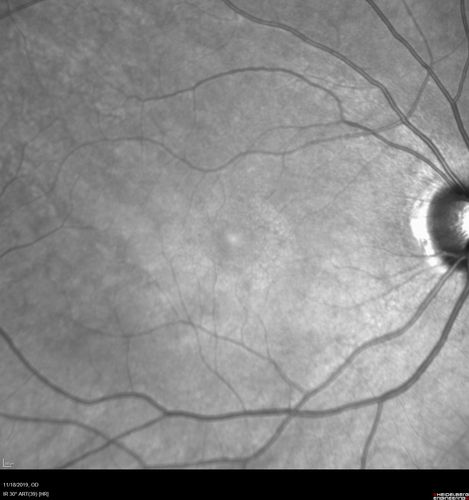 Plaquenil Toxicity - 4 years use
47 year old female She started plaquenil 4 years ago for lupus with cutaneous findings.  She has never been on the plaquenil before.  Her renal function is normal (her husband is an internist) and she is not on Tamoxifen.  Stopped the medication about 2.5 weeks ago.  She noticed vision when she started the depacote.  She is also myopic. (-9.50)  

Her dose was 6.3 mg/kg.  She is 5'1