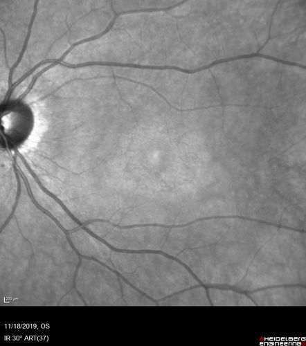 Plaquenil Toxicity - 4 years use
47 year old female She started plaquenil 4 years ago for lupus with cutaneous findings.  She has never been on the plaquenil before.  Her renal function is normal (her husband is an internist) and she is not on Tamoxifen.  Stopped the medication about 2.5 weeks ago.  She noticed vision when she started the depacote.  She is also myopic. (-9.50)  

Her dose was 6.3 mg/kg.  She is 5'1