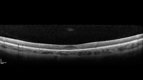 Plaquenil Toxicity - 4 years use
47 year old female She started plaquenil 4 years ago for lupus with cutaneous findings.  She has never been on the plaquenil before.  Her renal function is normal (her husband is an internist) and she is not on Tamoxifen.  Stopped the medication about 2.5 weeks ago.  She noticed vision when she started the depacote.  She is also myopic. (-9.50)  

Her dose was 6.3 mg/kg.  She is 5'1