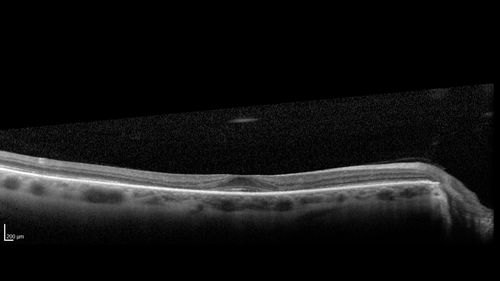 Plaquenil Toxicity - 4 years use
47 year old female She started plaquenil 4 years ago for lupus with cutaneous findings.  She has never been on the plaquenil before.  Her renal function is normal (her husband is an internist) and she is not on Tamoxifen.  Stopped the medication about 2.5 weeks ago.  She noticed vision when she started the depacote.  She is also myopic. (-9.50)  

Her dose was 6.3 mg/kg.  She is 5'1